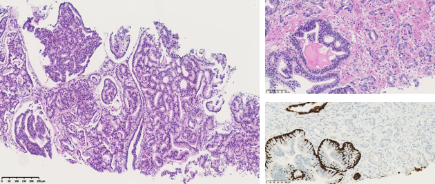 coupe histologique montrant un cancer de la prostate