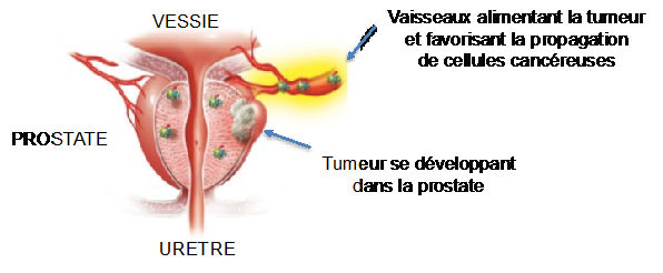 La prostate - Cancer de la prostate