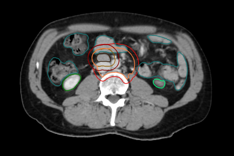 tumeur testiculaire - IRA II - radiothérapie ciblant un ganglion unique et épargnant les tissus sains avoisinants