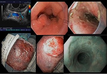 Image 2 resection barrett avec tumeur pT1m3 R0 redim.jpg