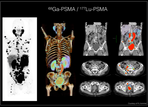 Nouvelles techniques d’imagerie médicale cancer prostate_2.png