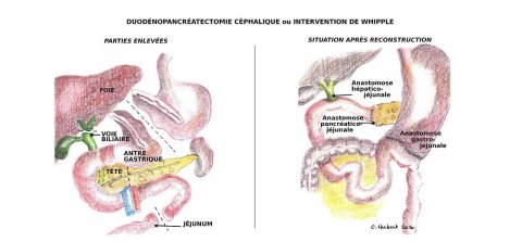 WHIPPLE CH_DS redim 1121x521 recadre_1.jpg