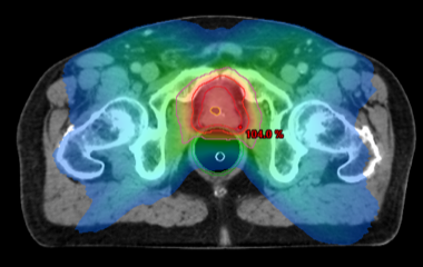 doses de radiothérapie administrées sur la prostate.png