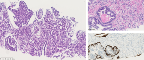 lames biopie prostate_1.png