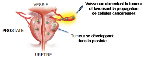 schéma tumeur prostate.png